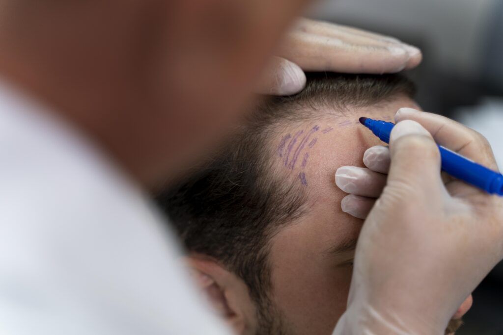 adult-male-doing-follicular-unit-extraction