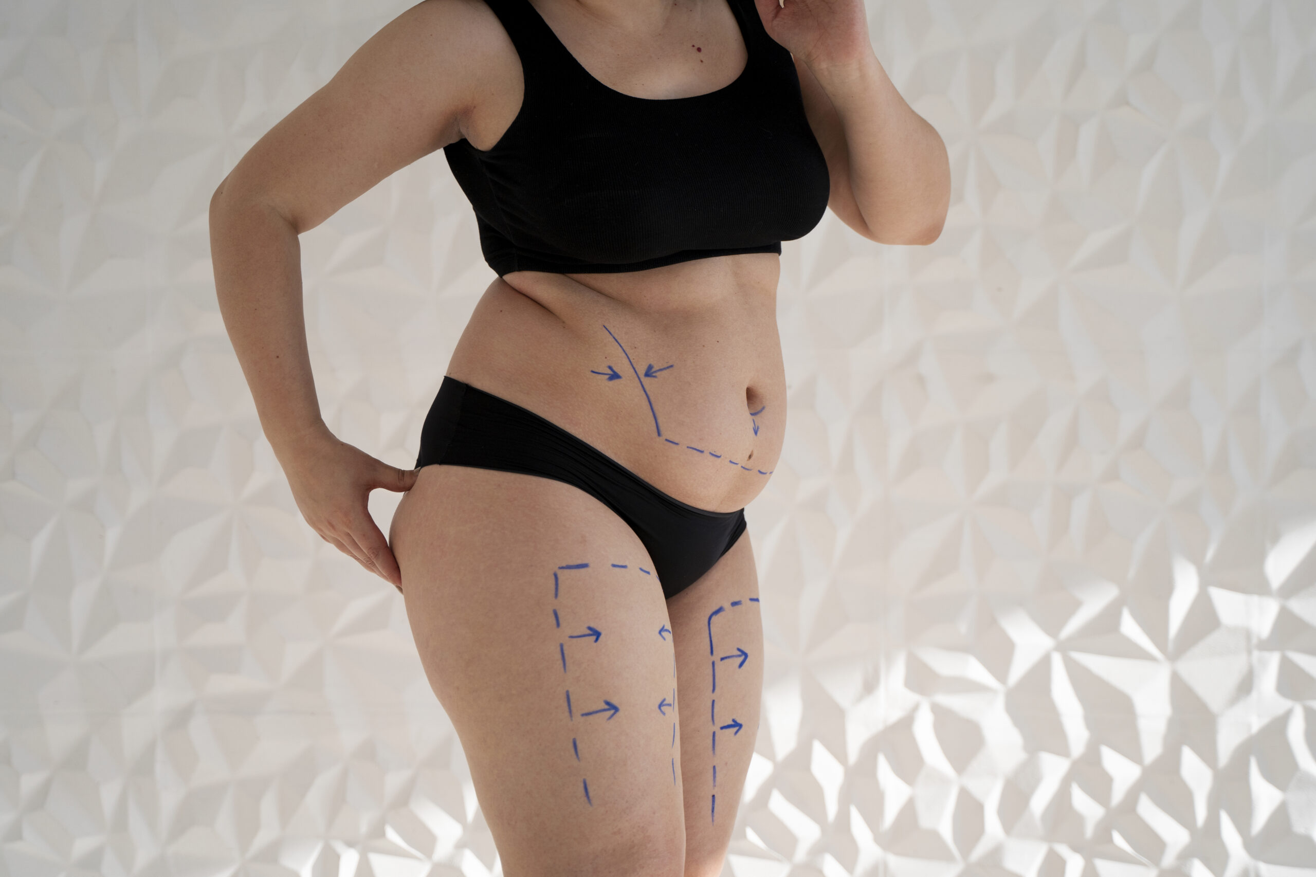 Liposuction