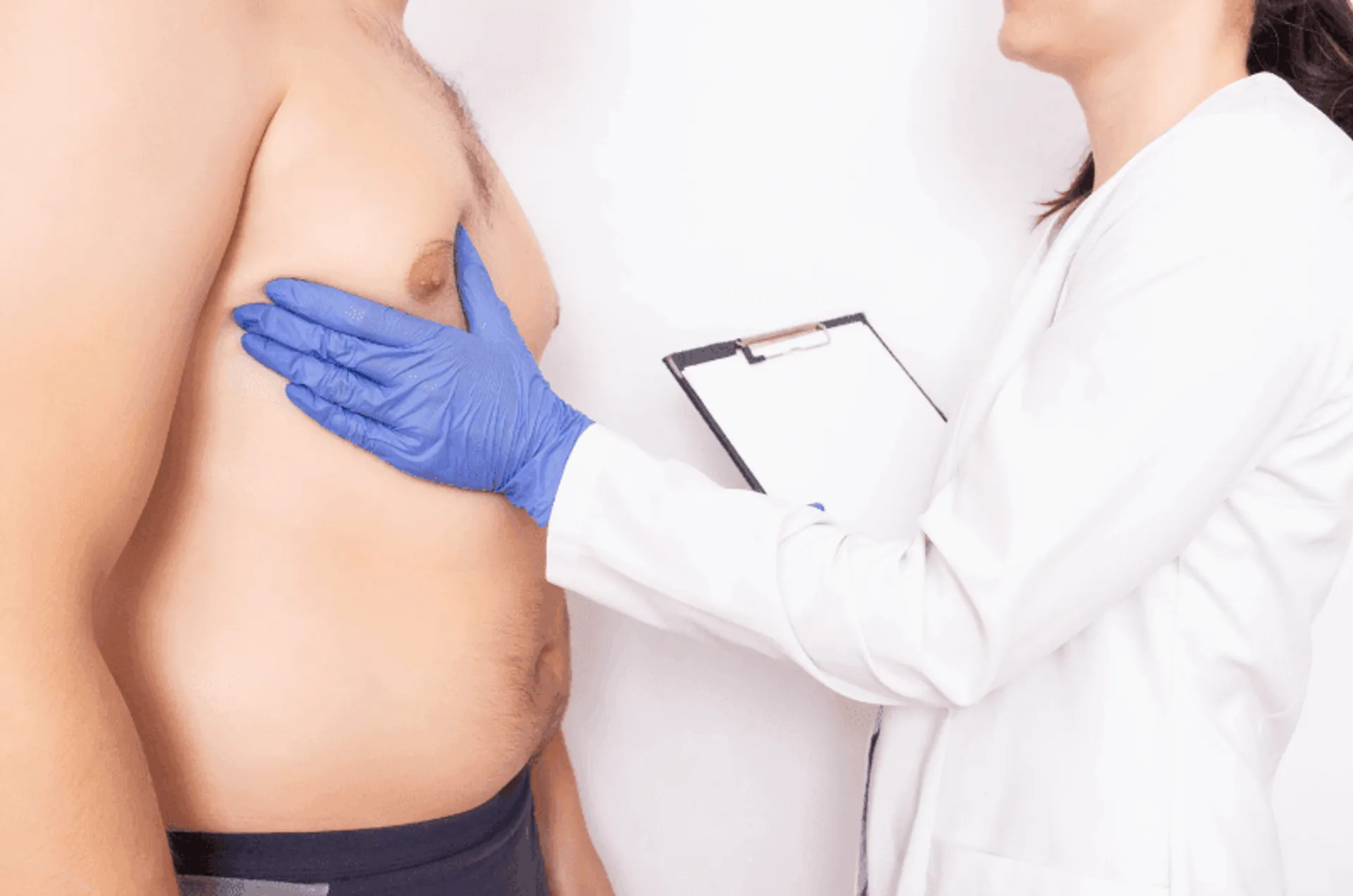 Gynecomastia